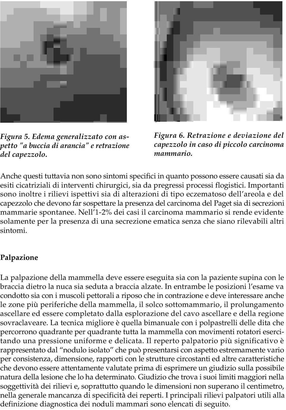 Importanti sono inoltre i rilievi ispettivi sia di alterazioni di tipo eczematoso dell areola e del capezzolo che devono far sospettare la presenza del carcinoma del Paget sia di secrezioni mammarie