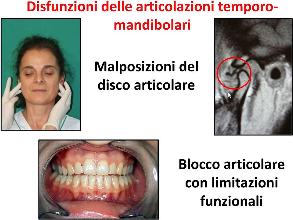 del disco articolare Blocco