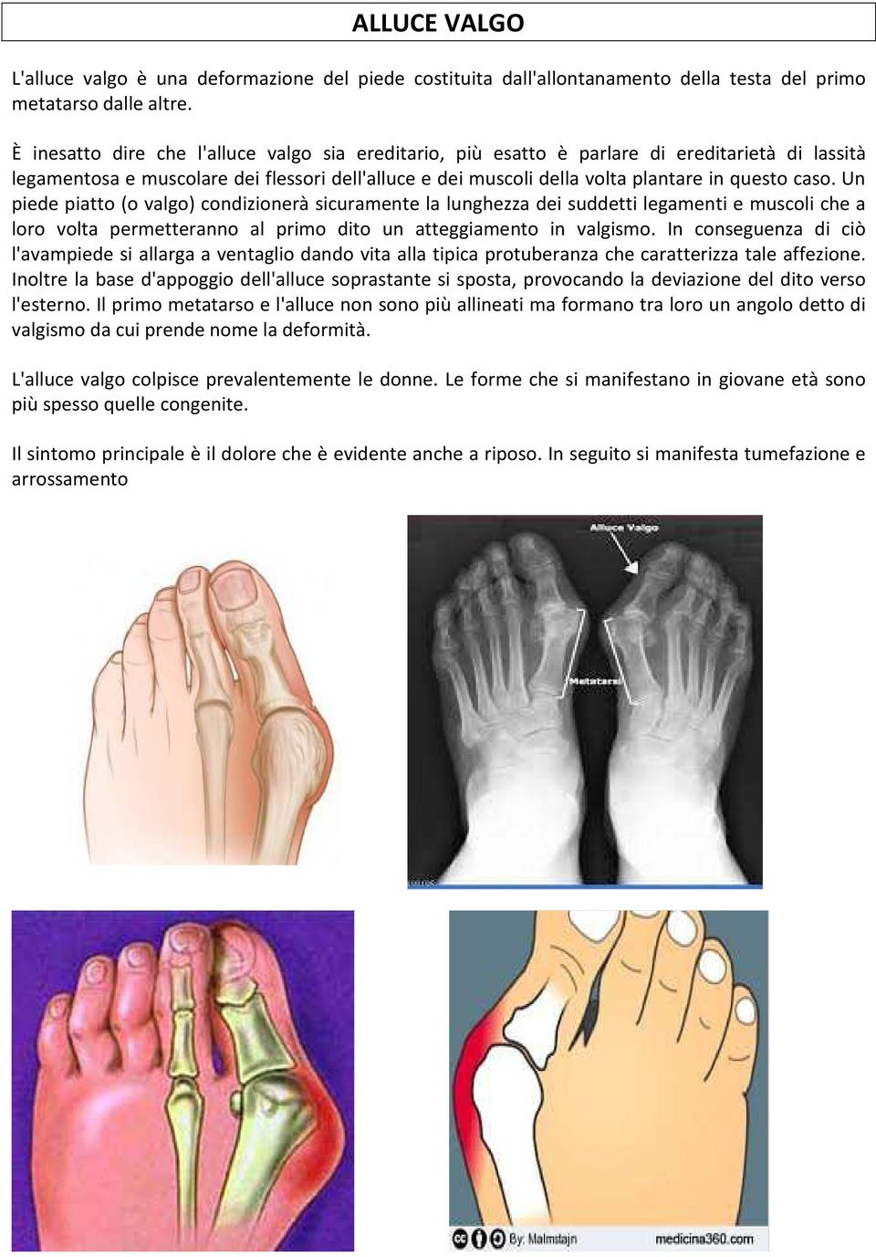 Un piede piatto (o valgo) condizionerà sicuramente la lunghezza dei suddetti legamenti e muscoli che a loro volta permetteranno al primo dito un atteggiamento in valgismo.