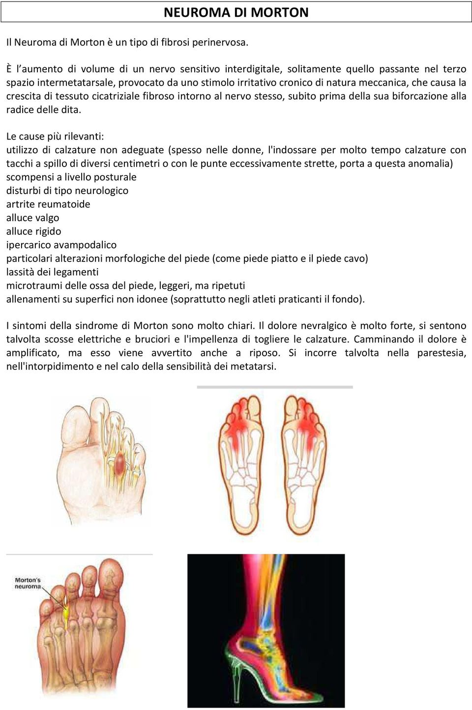 crescita di tessuto cicatriziale fibroso intorno al nervo stesso, subito prima della sua biforcazione alla radice delle dita.