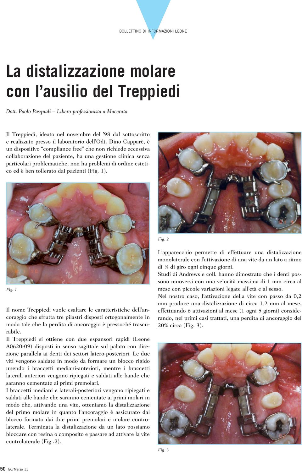 Dino Capparè, è un dispositivo compliance free che non richiede eccessiva collaborazione del paziente, ha una gestione clinica senza particolari problematiche, non ha problemi di ordine estetico ed è