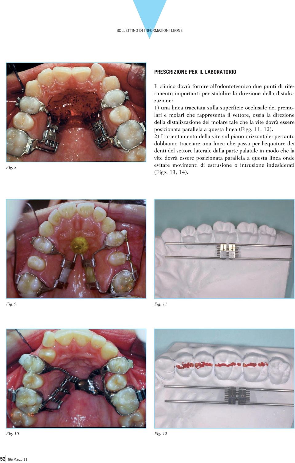 premolari e molari che rappresenta il vettore, ossia la direzione della distalizzazione del molare tale che la vite dovrà essere posizionata parallela a questa linea (Figg. 11, 12).