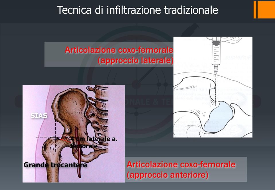 laterale) SIAS 4 cm laterale a.