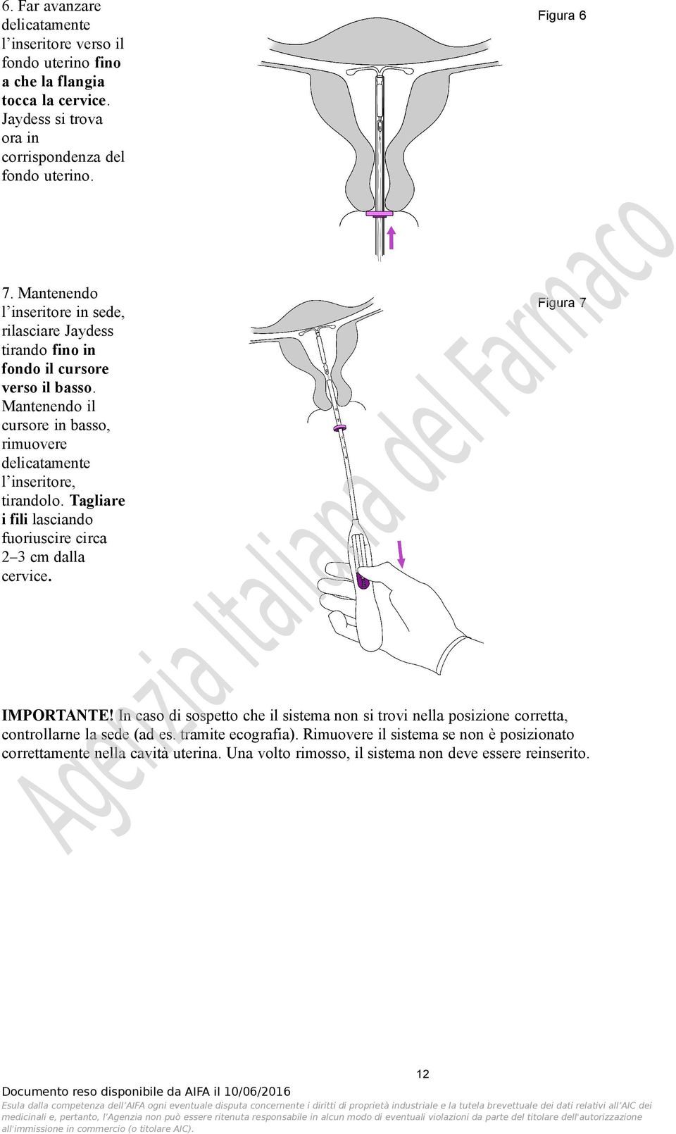 Mantenendo il cursore in basso, rimuovere delicatamente l inseritore, tirandolo. Tagliare i fili lasciando fuoriuscire circa 2 3 cm dalla cervice. Figura 7 IMPORTANTE!