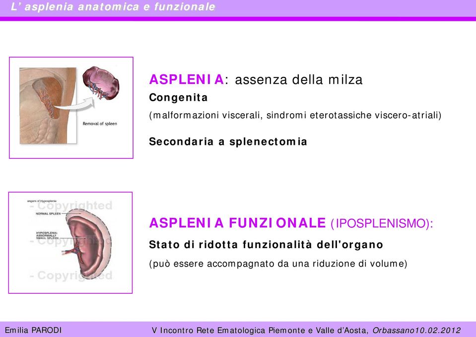 Secondaria a splenectomia ASPLENIA FUNZIONALE (IPOSPLENISMO): Stato di