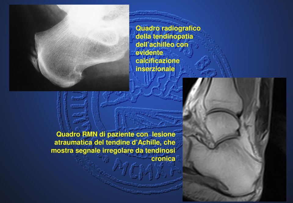 di paziente con lesione atraumatica del tendine d