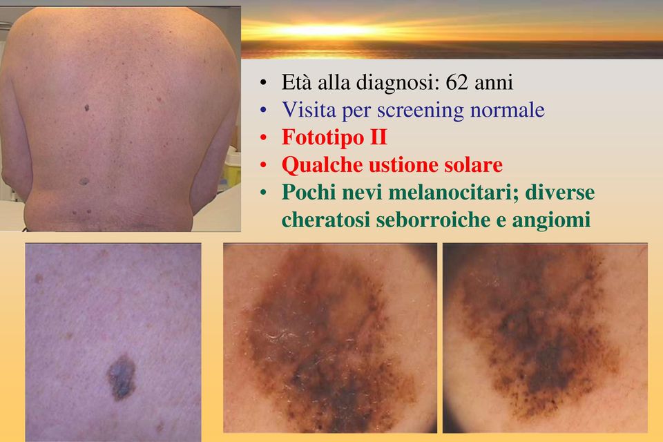 ustione solare Pochi nevi