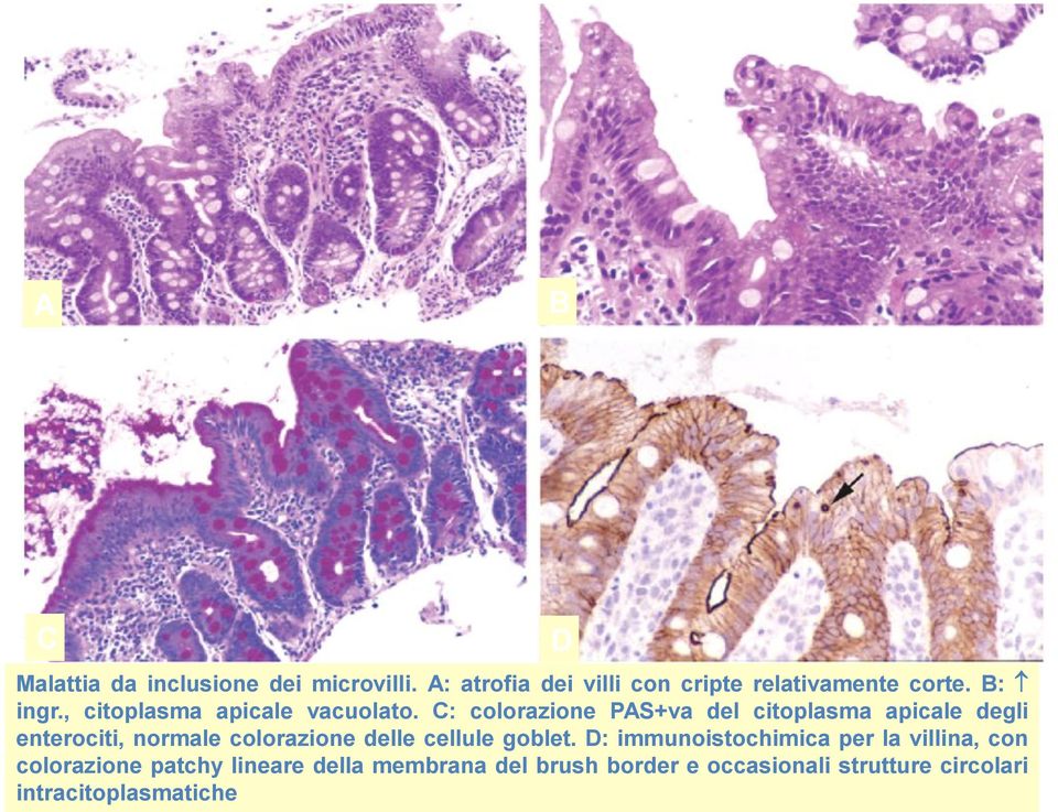 C: colorazione PAS+va del citoplasma apicale degli enterociti, normale colorazione delle cellule