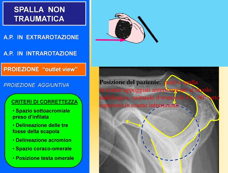 Delineazione acromion Spazio coraco-omerale Posizione testa omerale Posizione del paziente: petto e spalla in