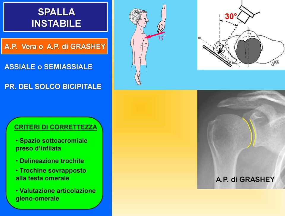 preso d infilata Delineazione trochite Trochine sovrapposto alla