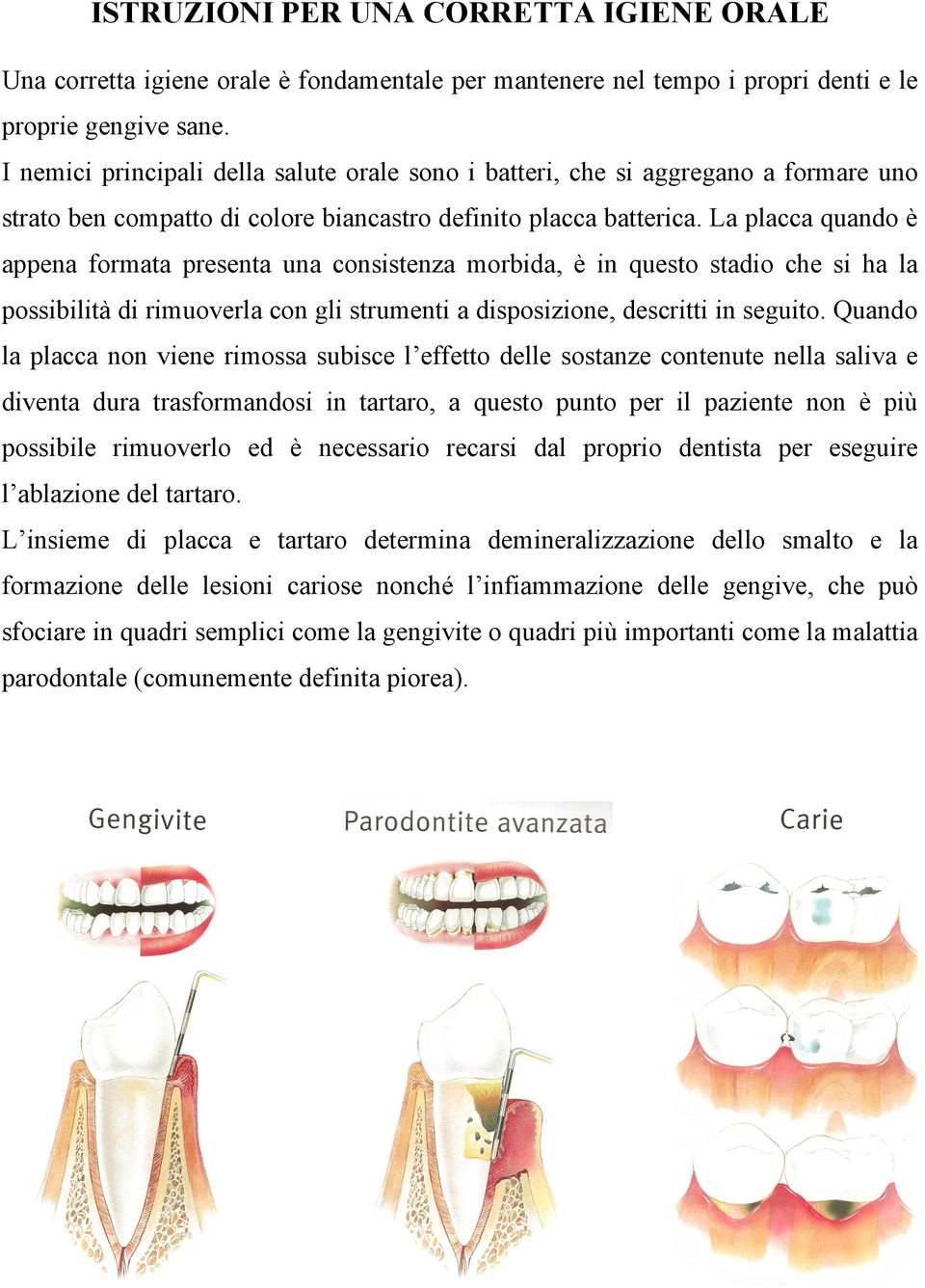 La placca quando è appena formata presenta una consistenza morbida, è in questo stadio che si ha la possibilità di rimuoverla con gli strumenti a disposizione, descritti in seguito.