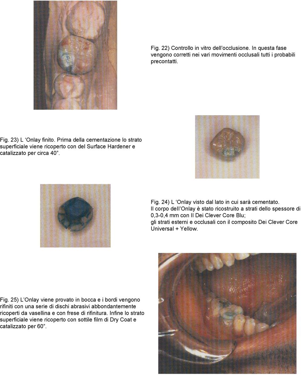 Il corpo deii Onlay è stato ricostruito a strati dello spessore di 0,3-0,4 mm con Il Dei Clever Core Blu; gli strati esterni e occlusali con il composito Dei Clever Core Universal + Yellow. Fig.