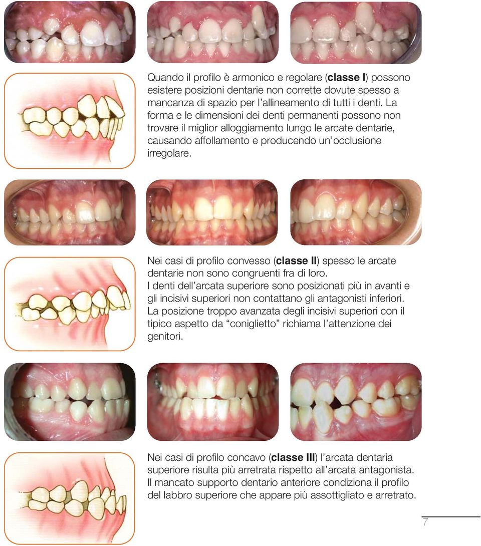 Nei casi di profilo convesso (classe II) spesso le arcate dentarie non sono congruenti fra di loro.