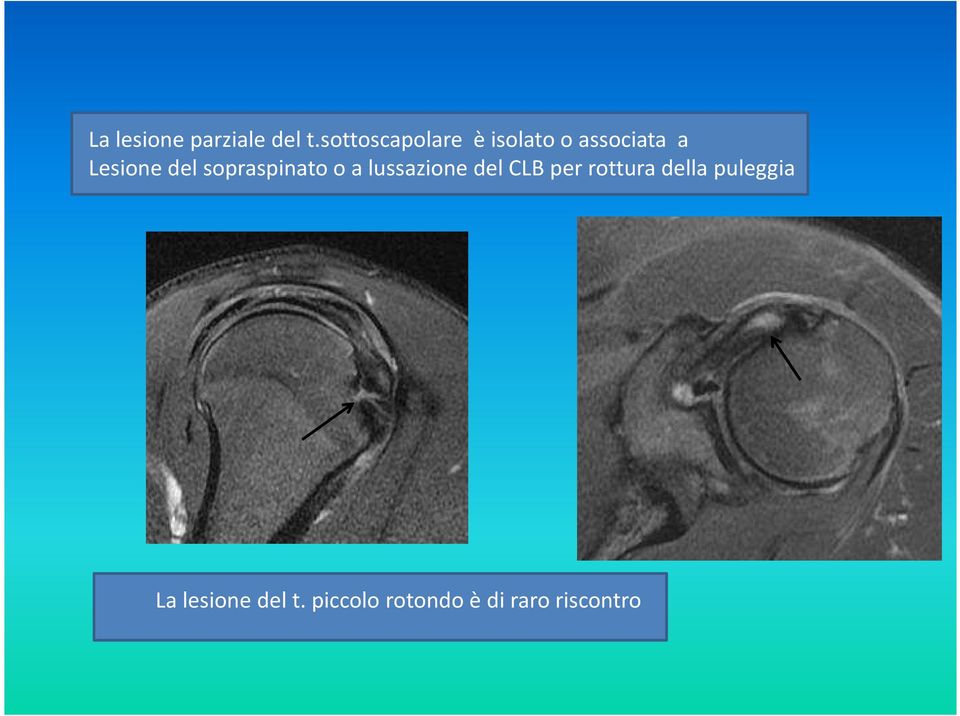 del sopraspinato o a lussazione del CLB per