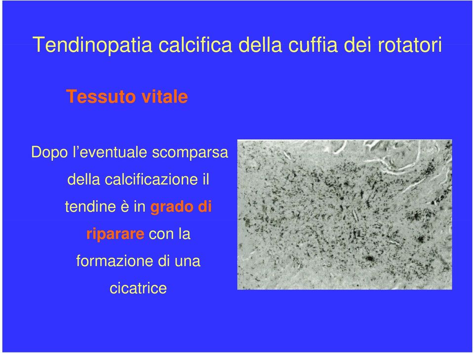 scomparsa della calcificazione il tendine è