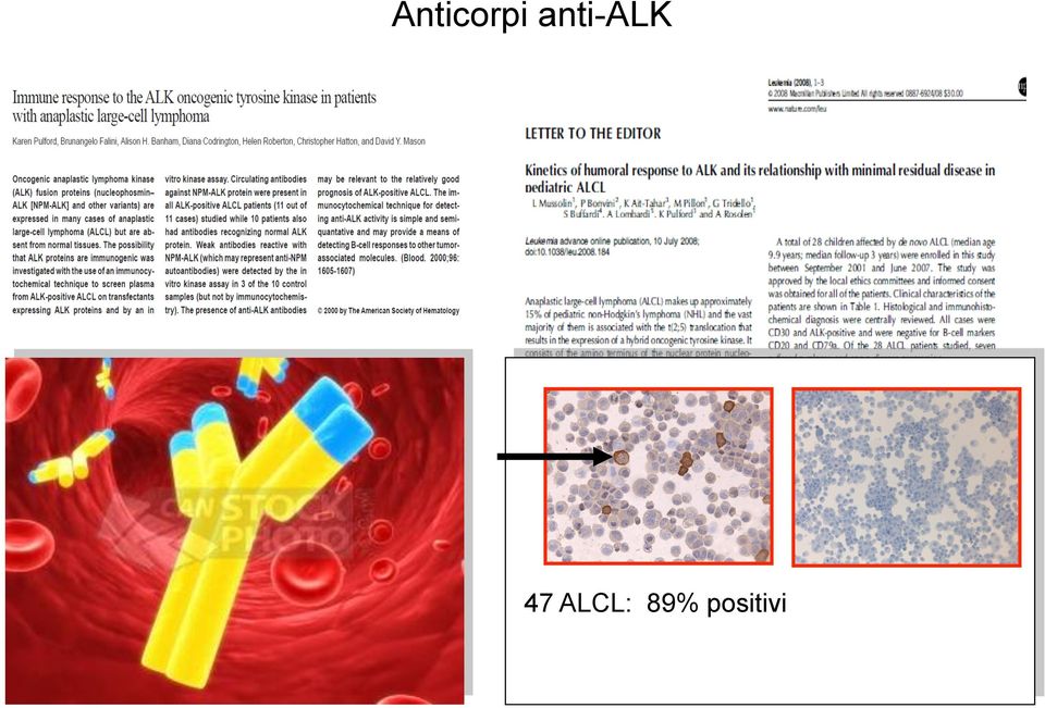 47 ALCL: