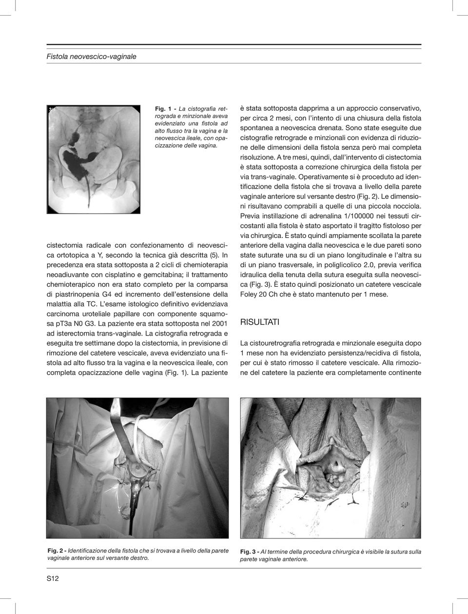 in precedenza era stata sottoposta a 2 cicli di chemioterapia neoadiuvante con cisplatino e gemcitabina; il trattamento chemioterapico non era stato completo per la comparsa di piastrinopenia G4 ed