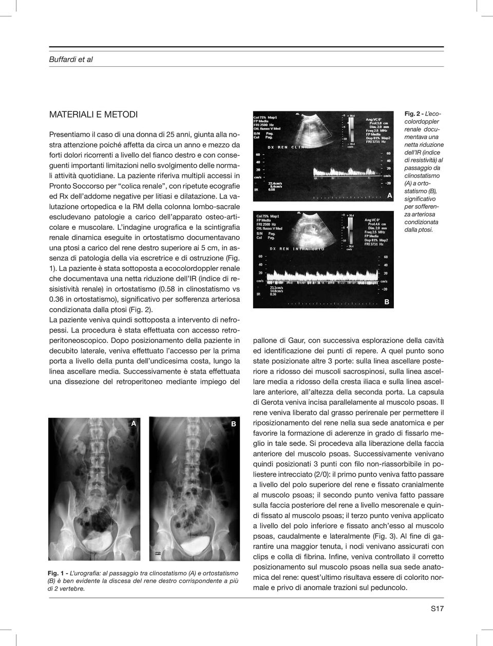 La paziente riferiva multipli accessi in Pronto Soccorso per colica renale, con ripetute ecografie ed rx dell addome negative per litiasi e dilatazione.