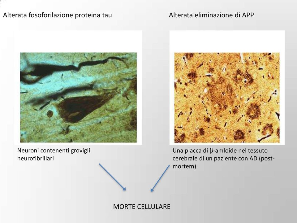 neurofibrillari Una placca di -amloide nel tessuto