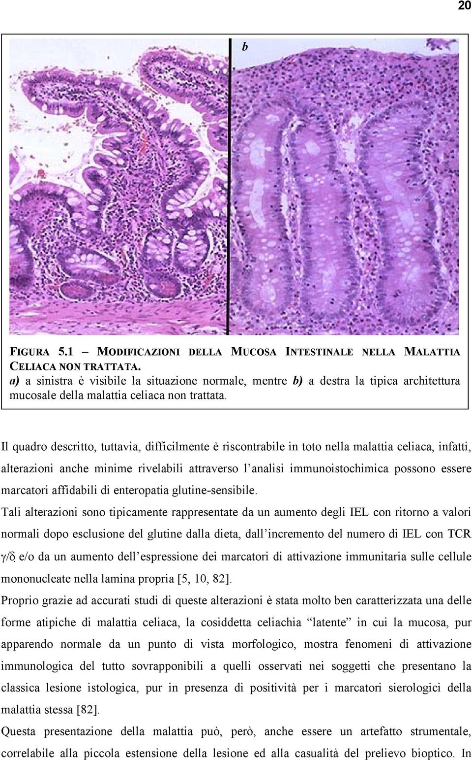 Il quadro descritto, tuttavia, difficilmente è riscontrabile in toto nella malattia celiaca, infatti, alterazioni anche minime rivelabili attraverso l analisi immunoistochimica possono essere