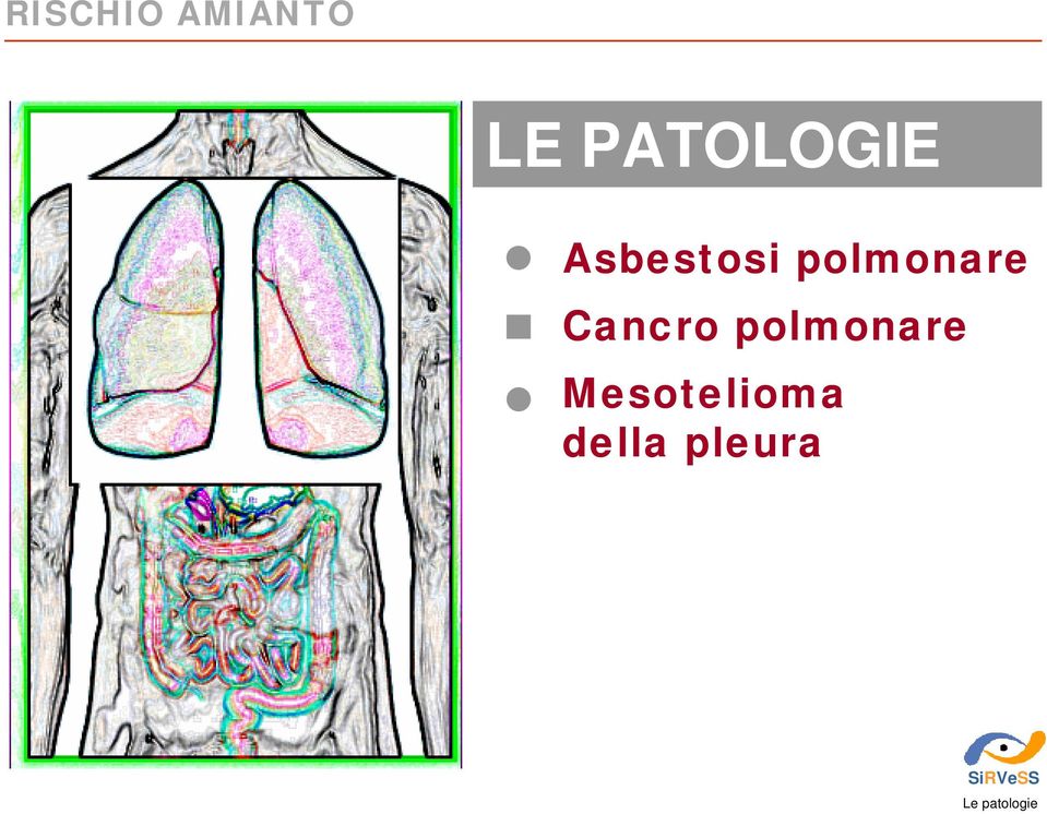 Cancro polmonare