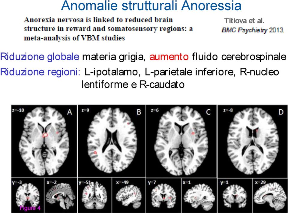 cerebrospinale Riduzione regioni: L-ipotalamo,