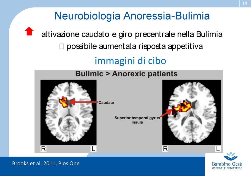 nella Bulimia possibile aumentata risposta