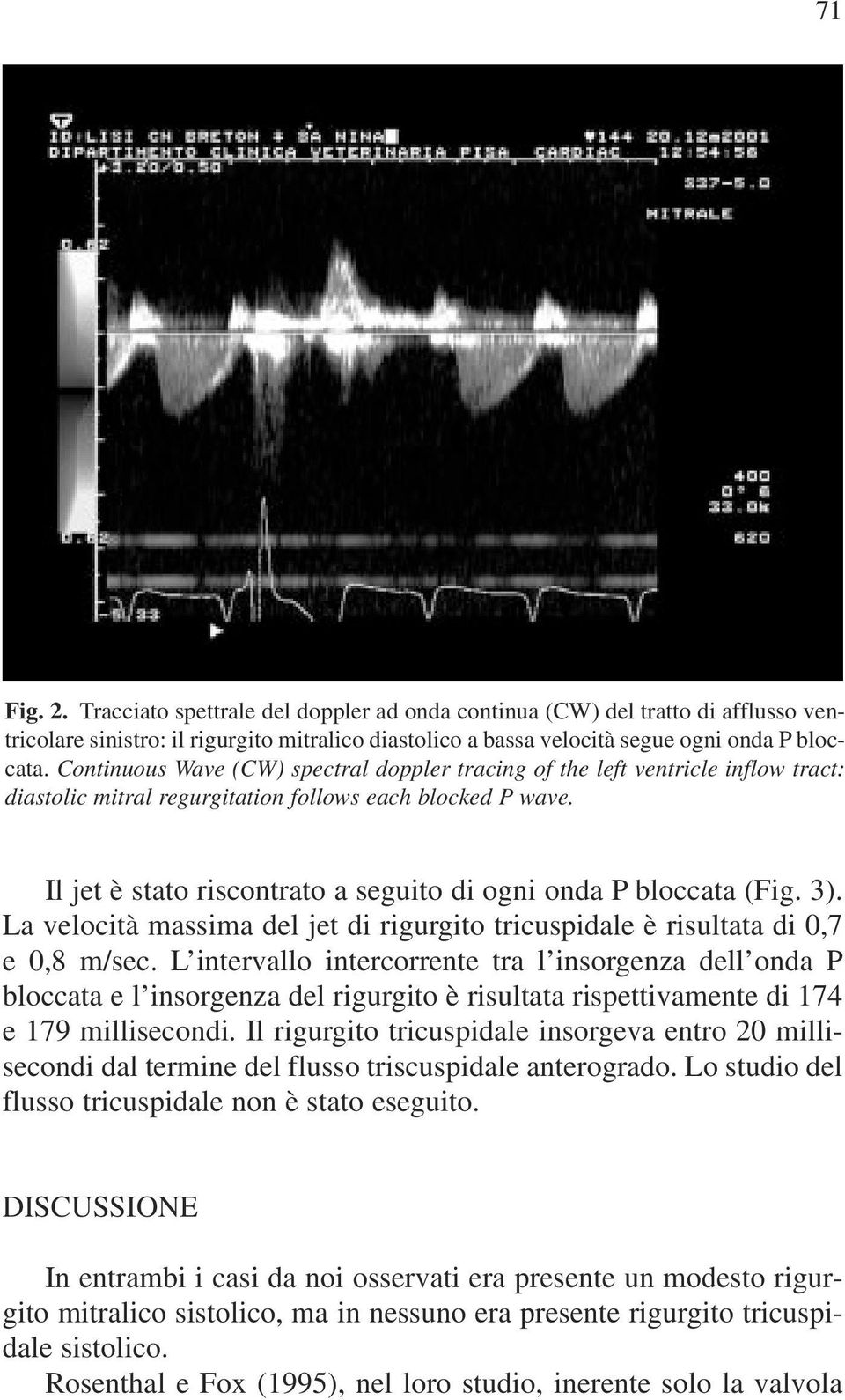 Il jet è stato riscontrato a seguito di ogni onda P bloccata (Fig. 3). La velocità massima del jet di rigurgito tricuspidale è risultata di 0,7 e 0,8 m/sec.