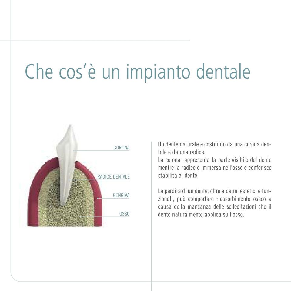 La corona rappresenta la parte visibile del dente mentre la radice è immersa nell osso e conferisce stabilità