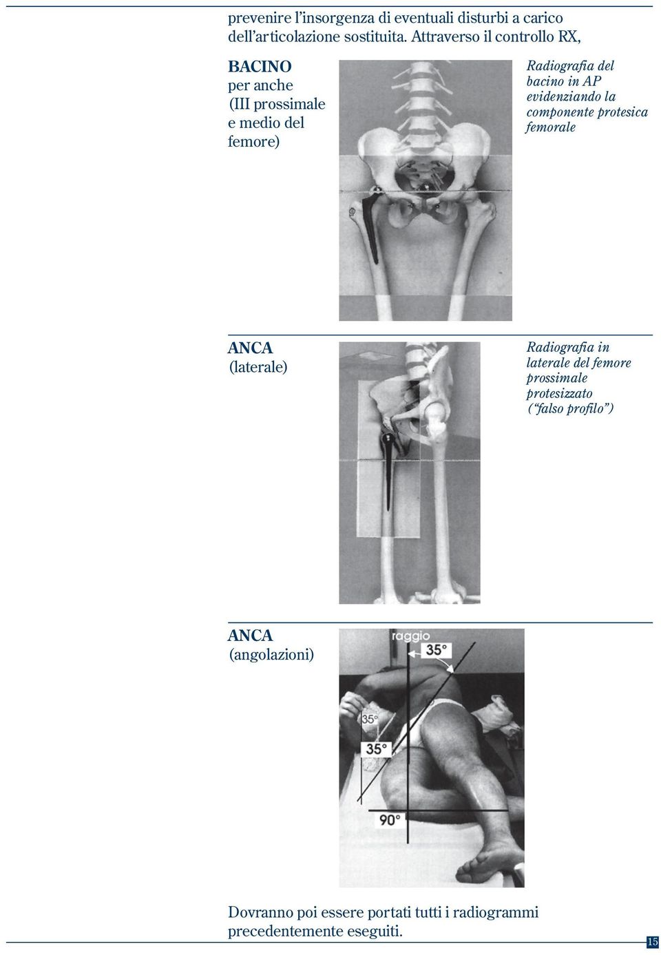AP evidenziando la componente protesica femorale ANCA (laterale) Radiografia in laterale del femore