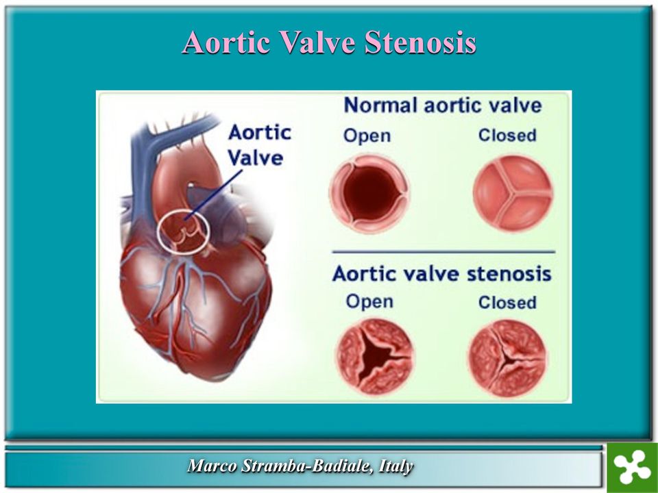 Stenosis