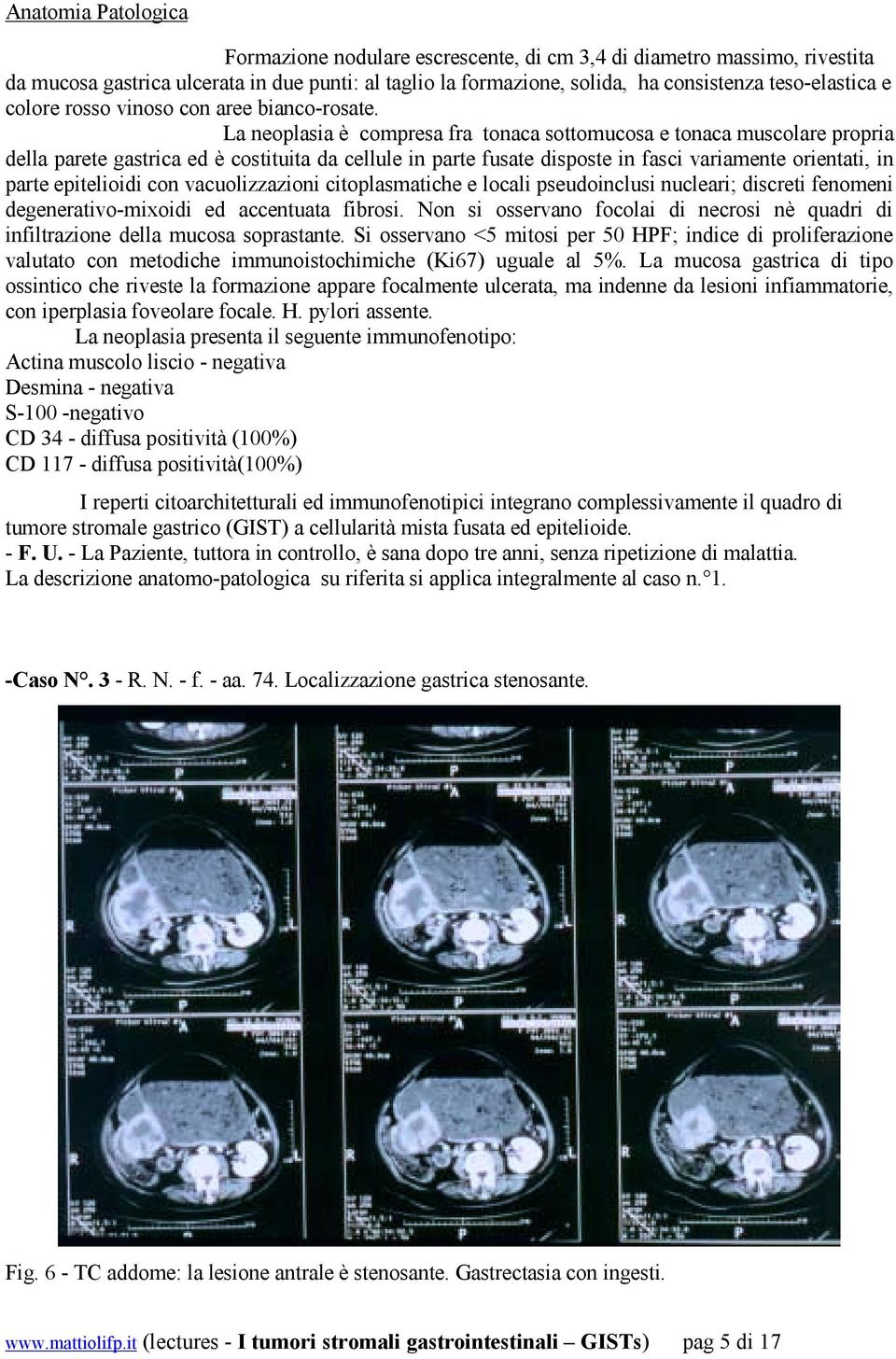 La neoplasia è compresa fra tonaca sottomucosa e tonaca muscolare propria della parete gastrica ed è costituita da cellule in parte fusate disposte in fasci variamente orientati, in parte epitelioidi