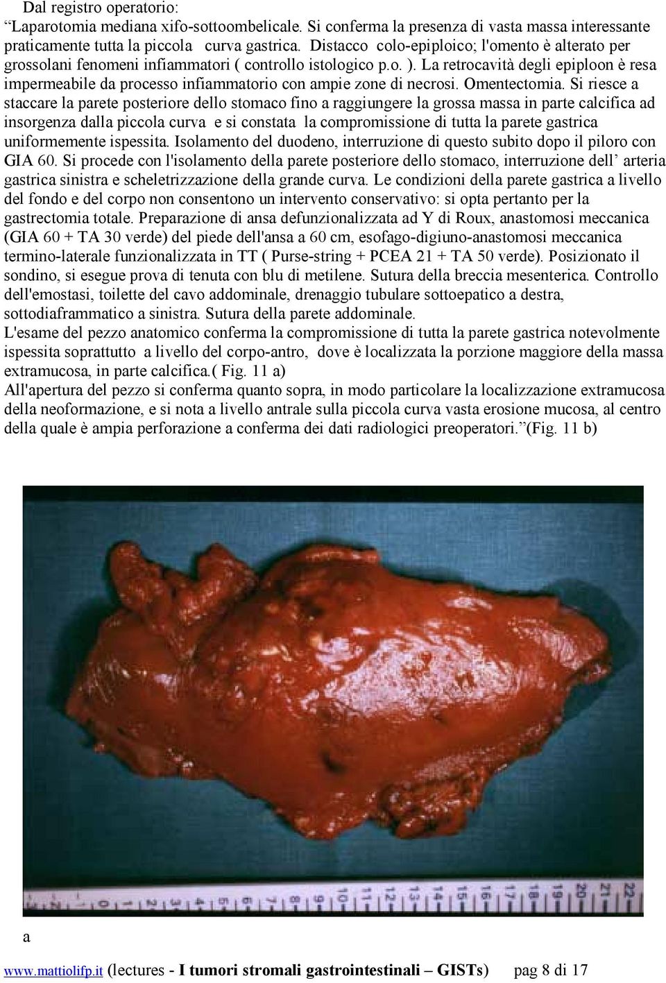 La retrocavità degli epiploon è resa impermeabile da processo infiammatorio con ampie zone di necrosi. Omentectomia.