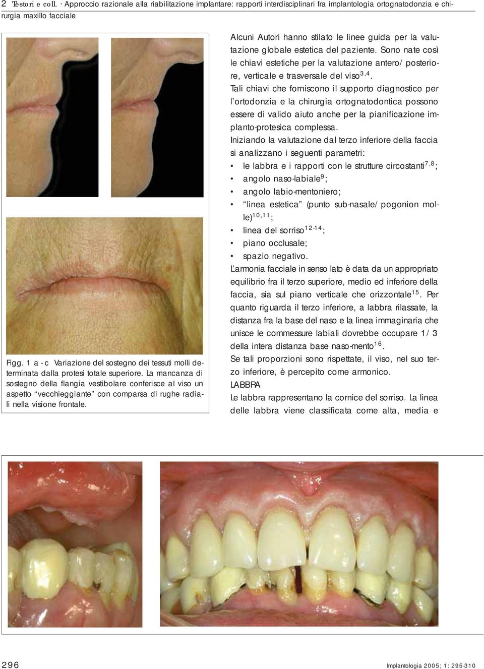 La mancanza di sosegno della flangia vesibolare conferisce al viso un aspeo vecchieggiane con comparsa di rughe radiali nella visione fronale.