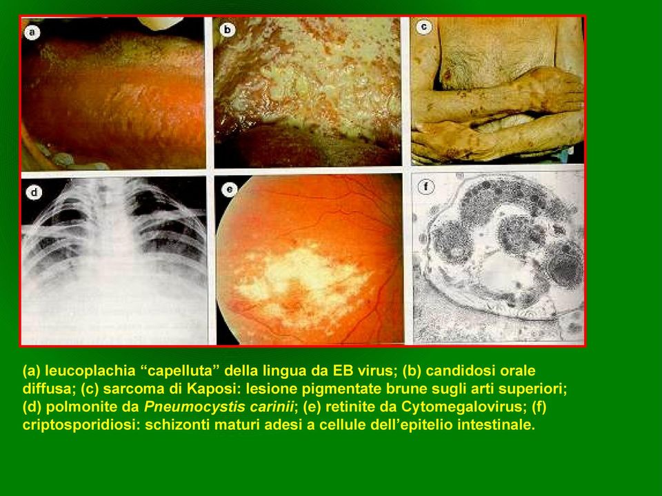 superiori; (d) polmonite da Pneumocystis carinii; (e) retinite da