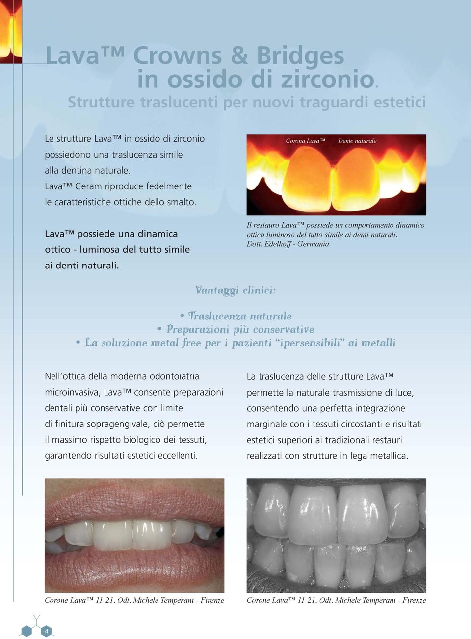 Il restauro Lava possiede un comportamento dinamico ottico luminoso del tutto simile ai denti naturali. Dott.