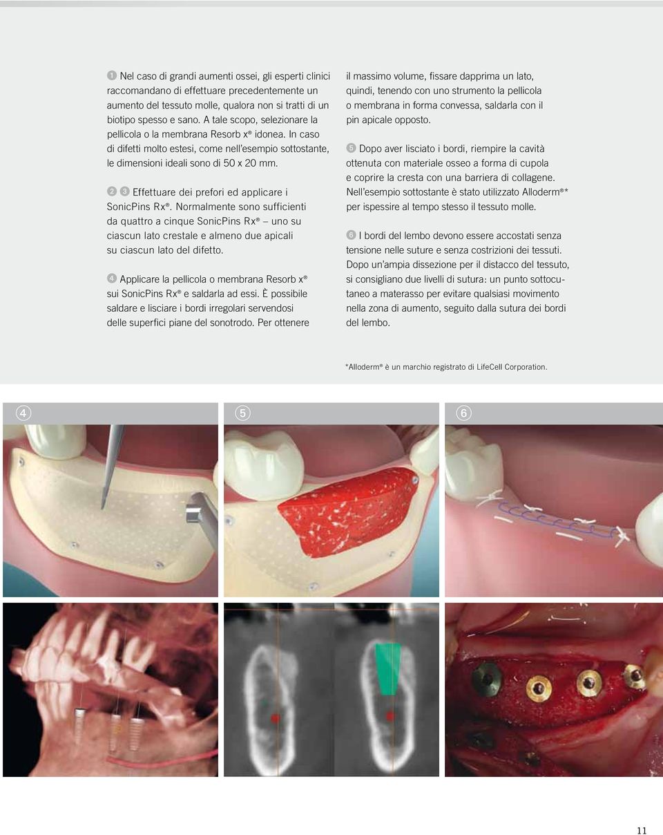 Effettuare dei prefori ed applicare i SonicPins Rx. Normalmente sono sufficienti da quattro a cinque SonicPins Rx uno su ciascun lato crestale e almeno due apicali su ciascun lato del difetto.