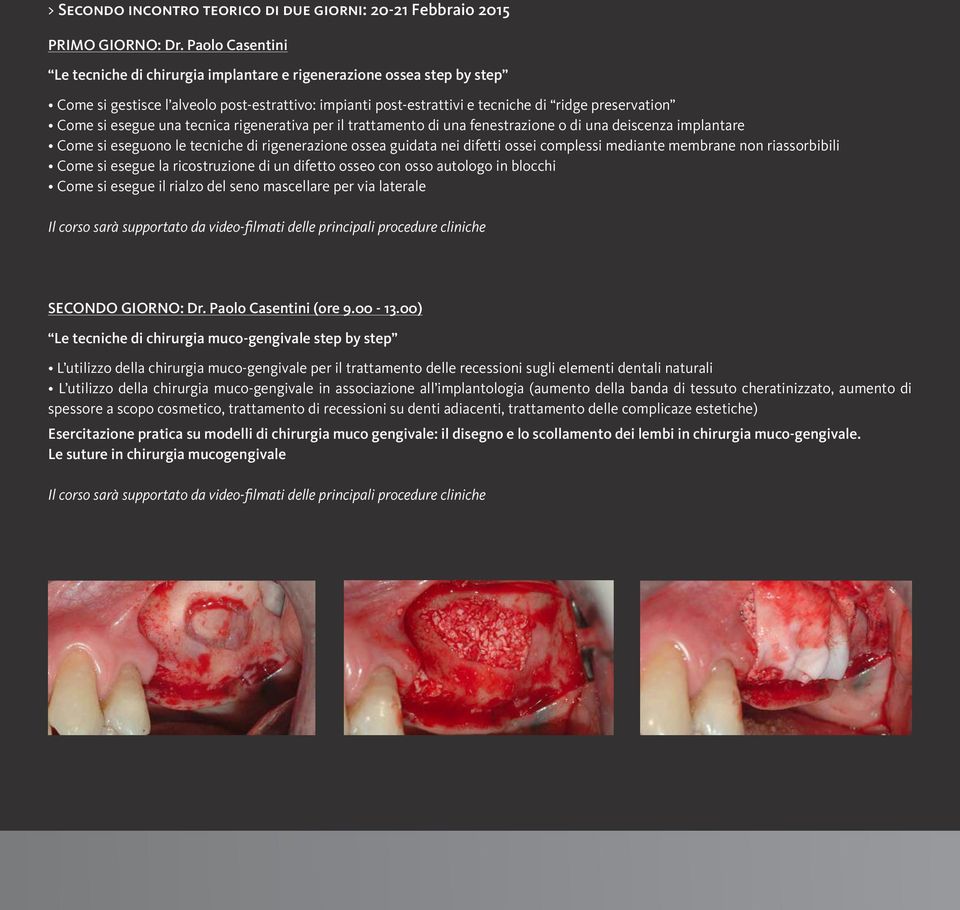 esegue una tecnica rigenerativa per il trattamento di una fenestrazione o di una deiscenza implantare Come si eseguono le tecniche di rigenerazione ossea guidata nei difetti ossei complessi mediante