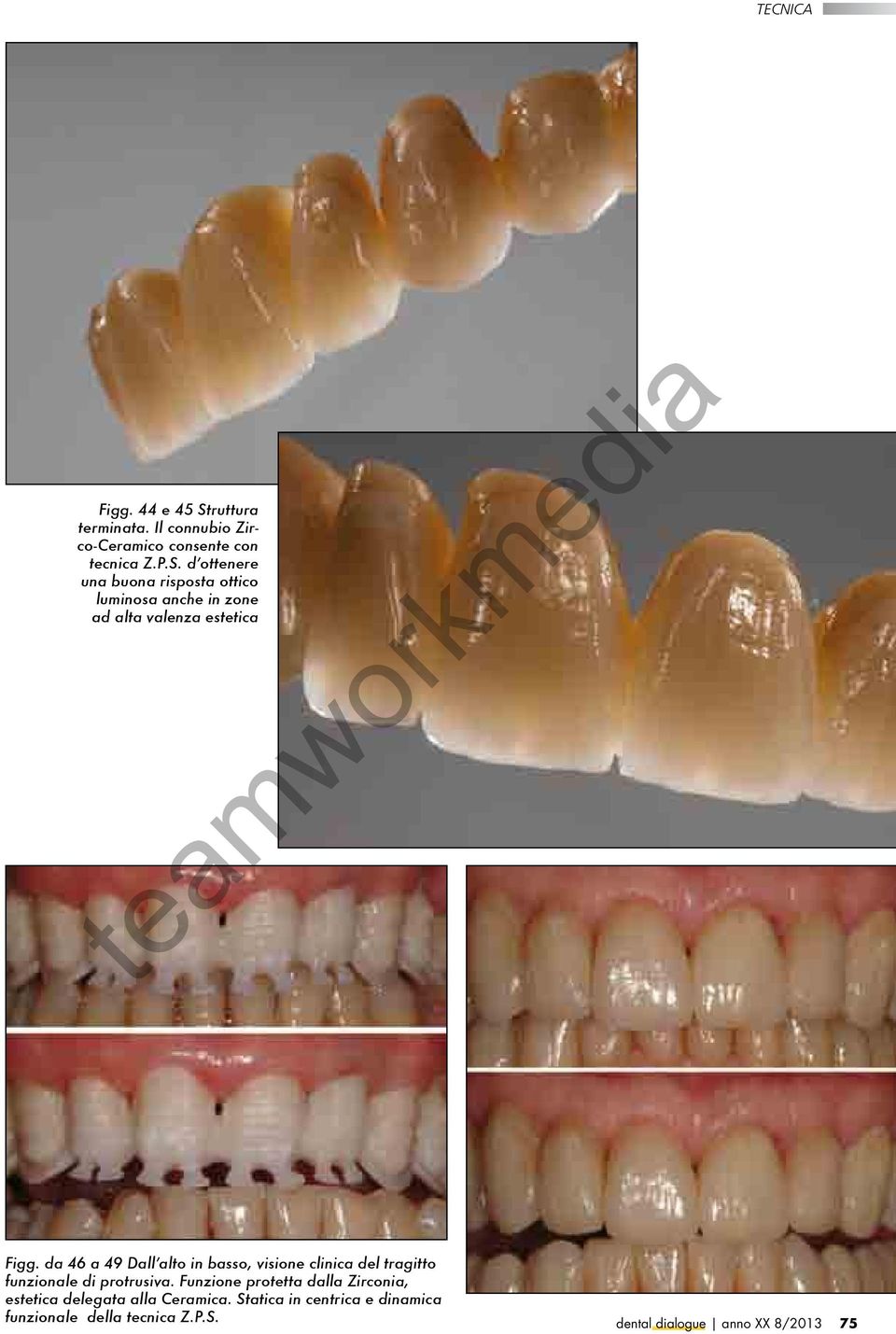 Funzione protetta dalla Zirconia, estetica delegata alla Ceramica.