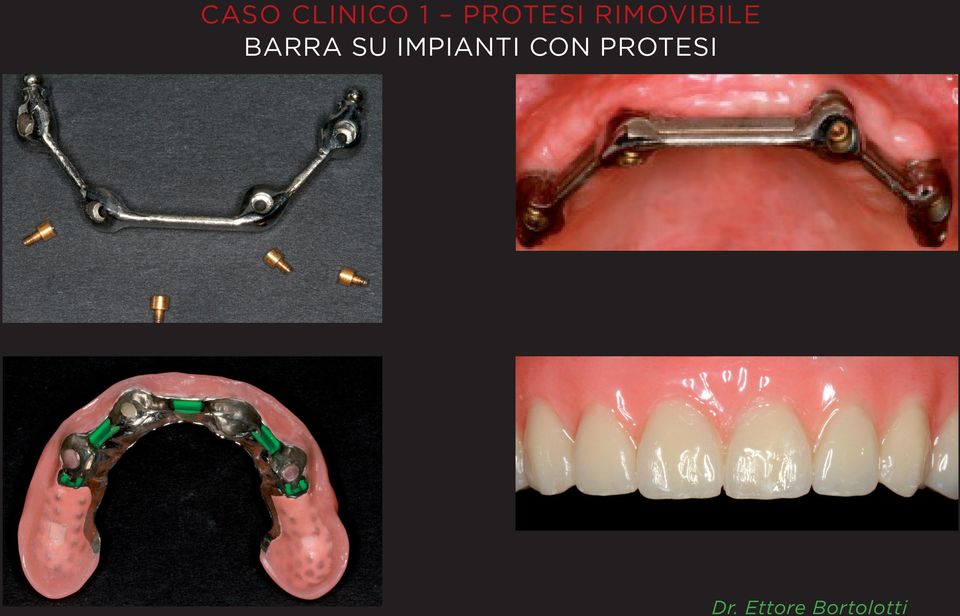 BARRA SU IMPIANTI CON