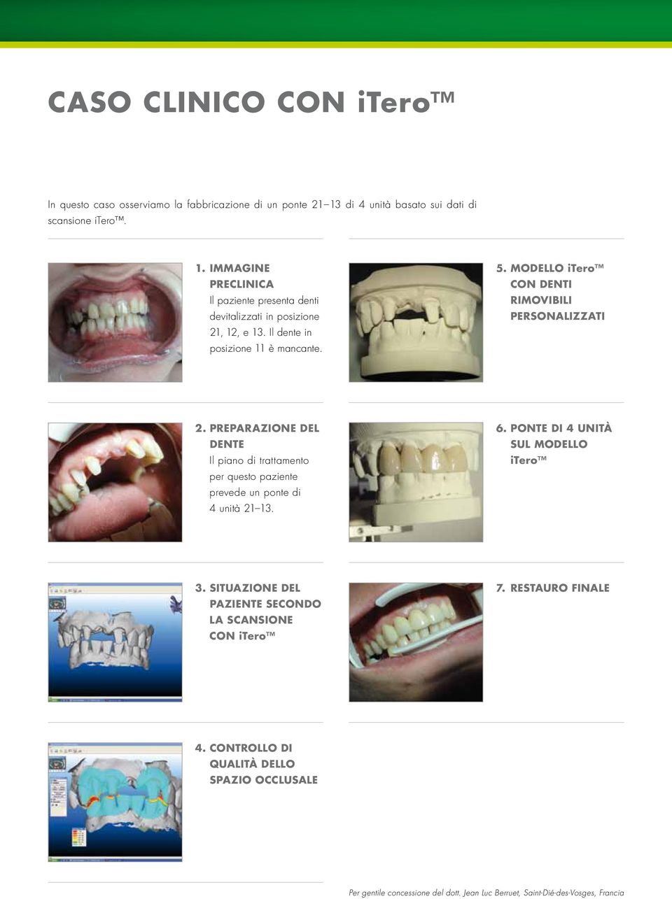 Il dente in posizione 11 è mancante. 5. modello itero con denti rimovibili PErsonalizzati 2.