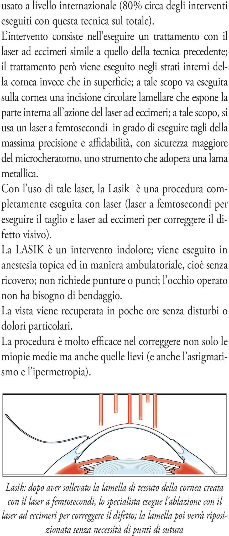 in superficie; a tale scopo va eseguita sulla cornea una incisione circolare lamellare che espone la parte interna all azione del laser ad eccimeri; a tale scopo, si usa un laser a femtosecondi in