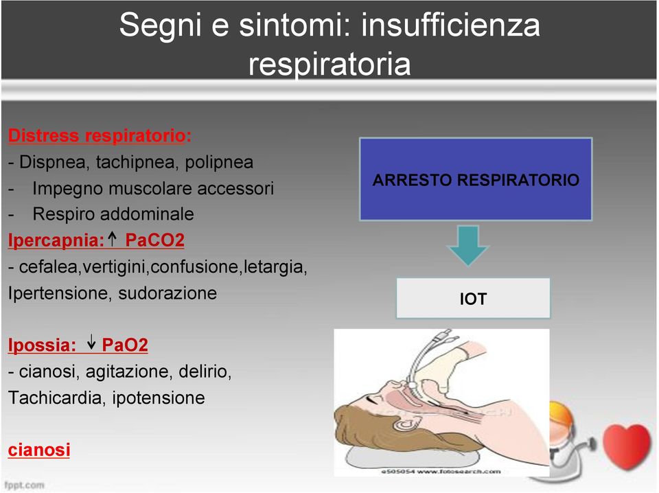 PaCO2 - cefalea,vertigini,confusione,letargia, Ipertensione, sudorazione ARRESTO