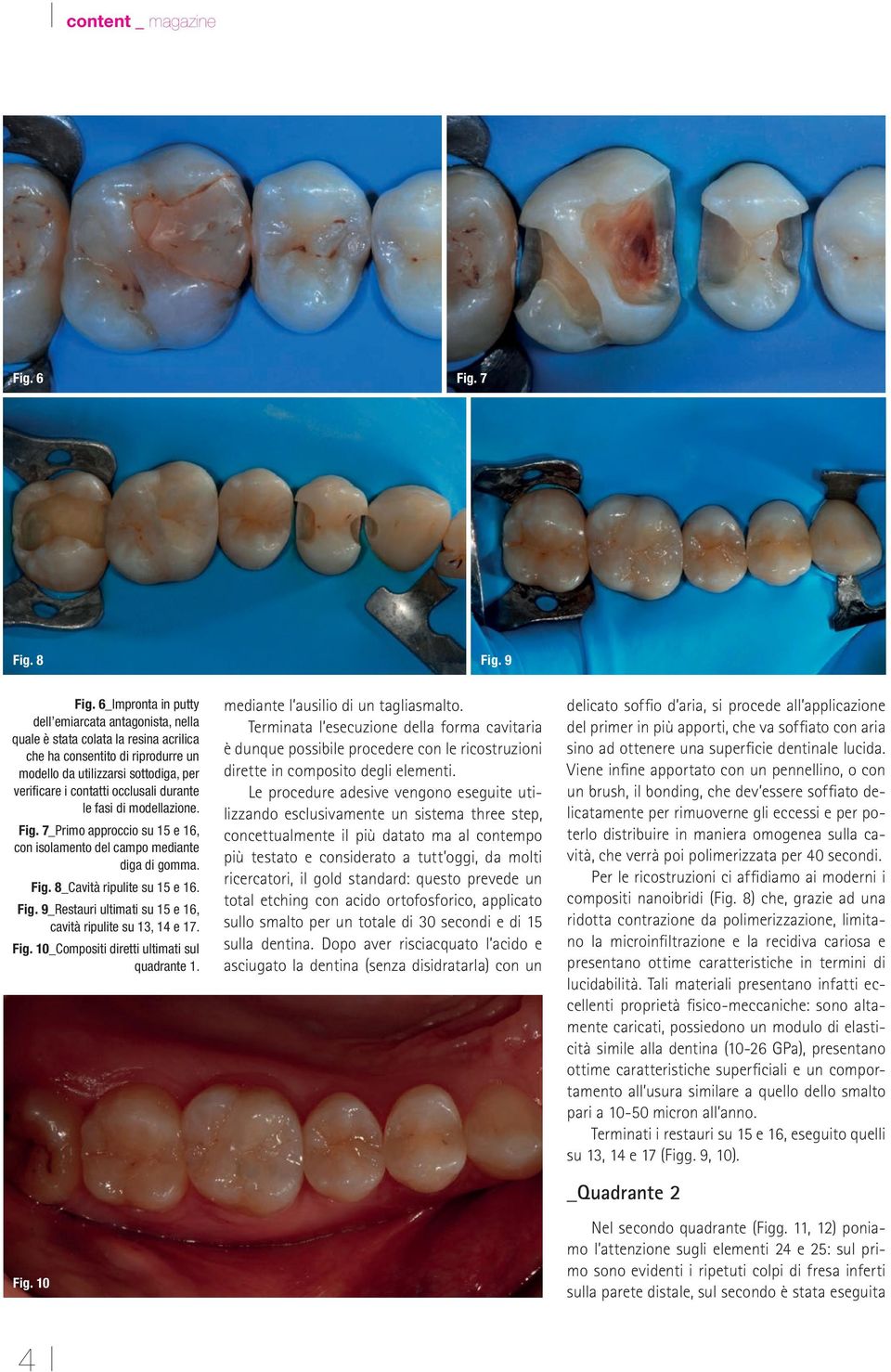durante le fasi di modellazione. Fig. 7_Primo approccio su 15 e 16, con isolamento del campo mediante diga di gomma. Fig. 8_Cavità ripulite su 15 e 16. Fig. 9_Restauri ultimati su 15 e 16, cavità ripulite su 13, 14 e 17.