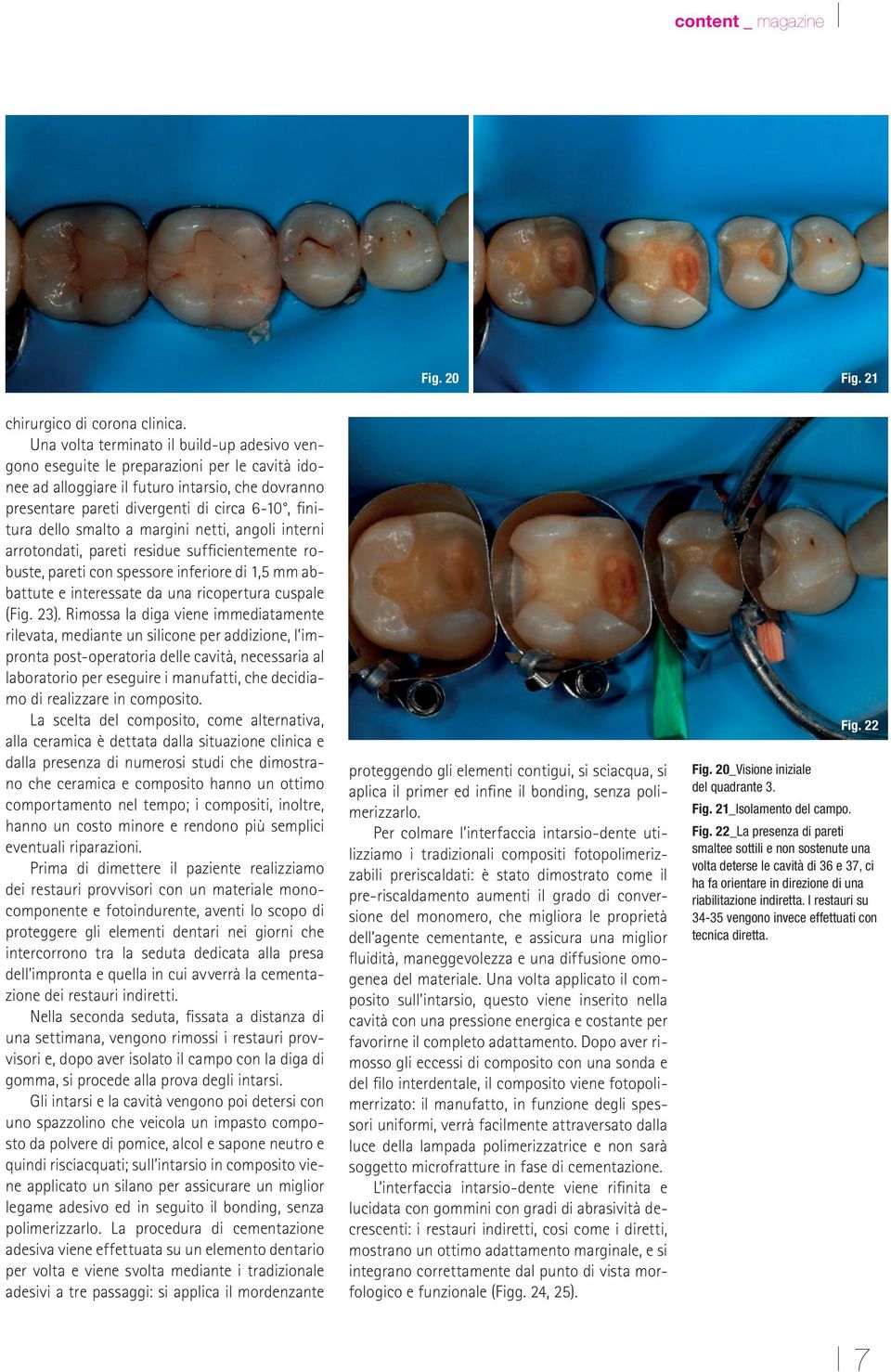 smalto a margini netti, angoli interni arrotondati, pareti residue sufficientemente robuste, pareti con spessore inferiore di 1,5 mm abbattute e interessate da una ricopertura cuspale (Fig. 23).