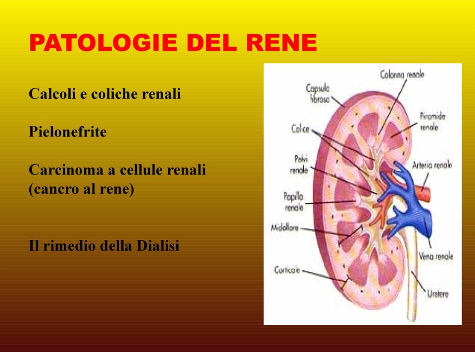 Carcinoma a cellule renali