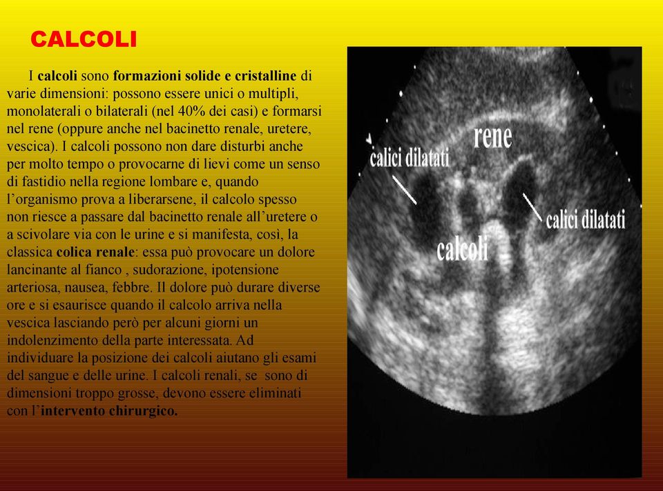 I calcoli possono non dare disturbi anche per molto tempo o provocarne di lievi come un senso di fastidio nella regione lombare e, quando l organismo prova a liberarsene, il calcolo spesso non riesce