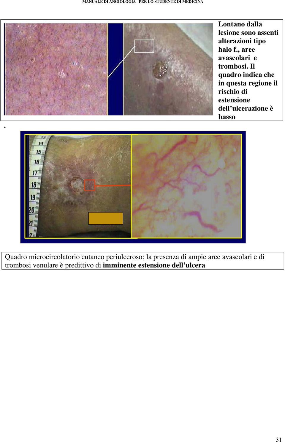 Il quadro indica che in questa regione il rischio di estensione dell ulcerazione è