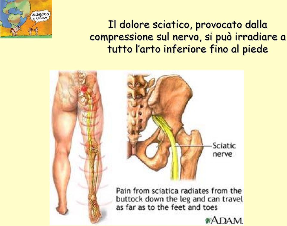 sul nervo, si può irradiare