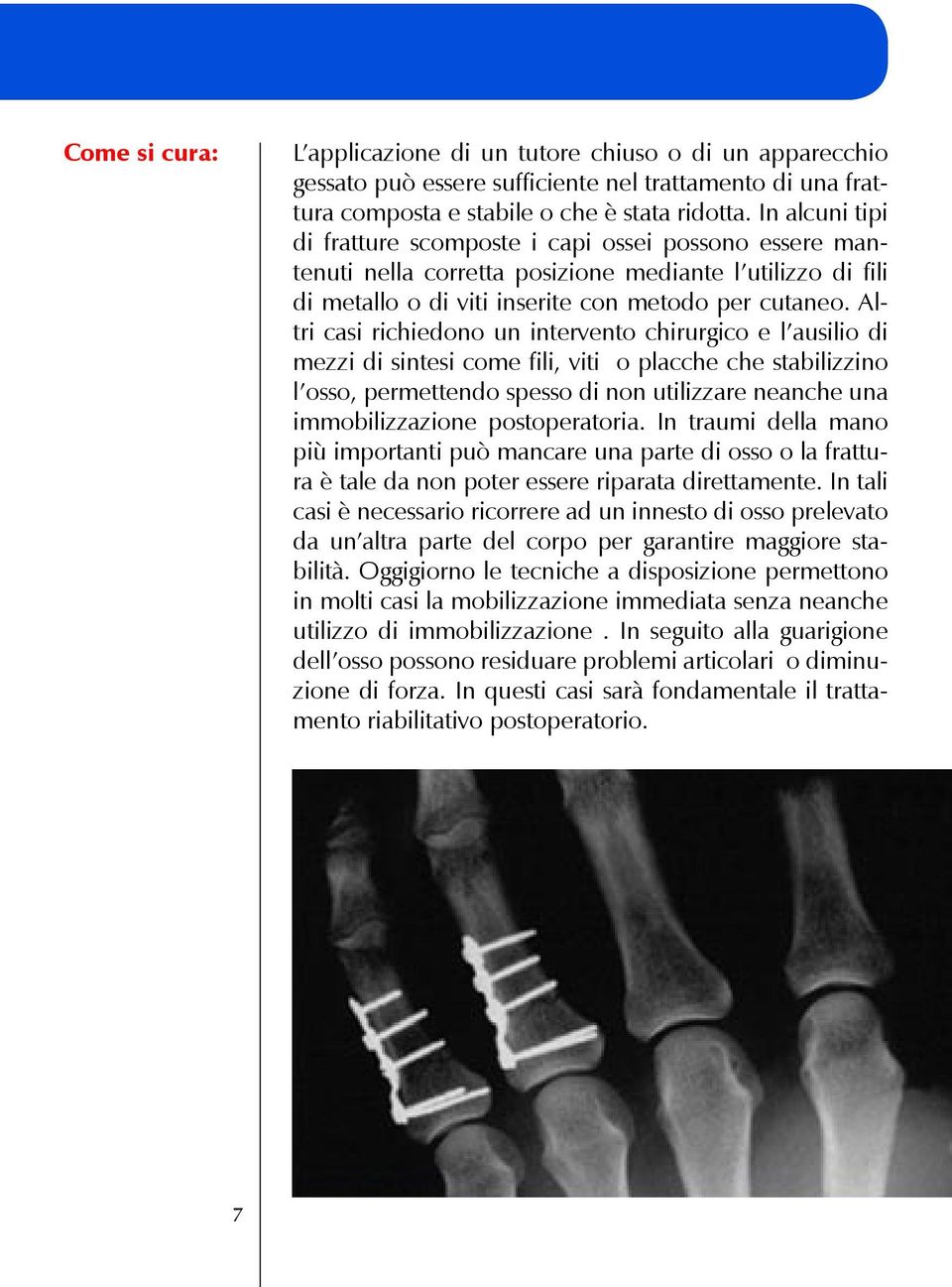 Altri casi richiedono un intervento chirurgico e l ausilio di mezzi di sintesi come fili, viti o placche che stabilizzino l osso, permettendo spesso di non utilizzare neanche una immobilizzazione